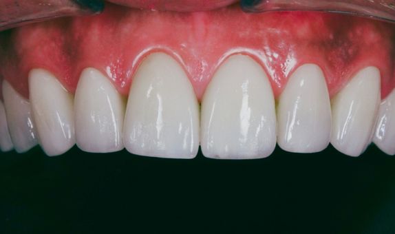 Wedding Dental Package