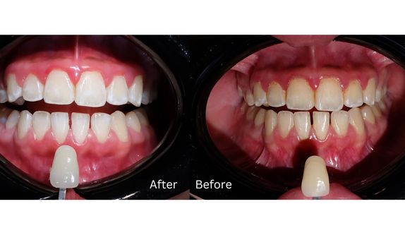 Teeth Whitening