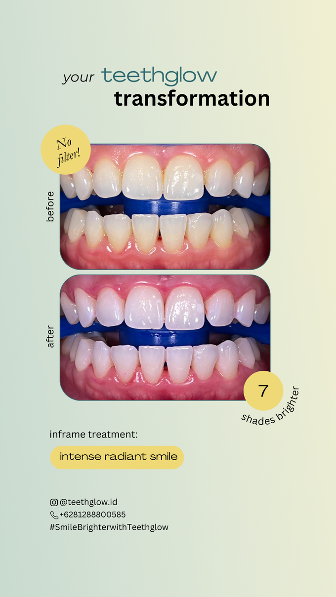 Teeth Whitening Results by Teethglow Teeth Whitening Studio - 002
