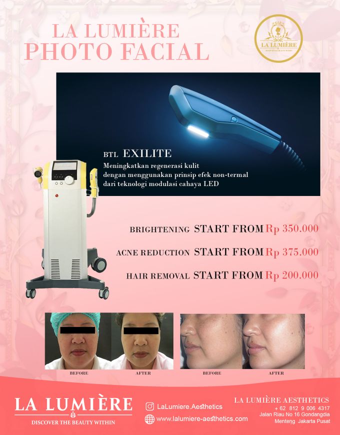 BTL EXILITE SKIN REJUV & BRIGHTENING by la lumiere aesthetics - 007 BTL EXILITE SKIN REJUV & BRIGHTENING by la lumiere aesthetics - 007