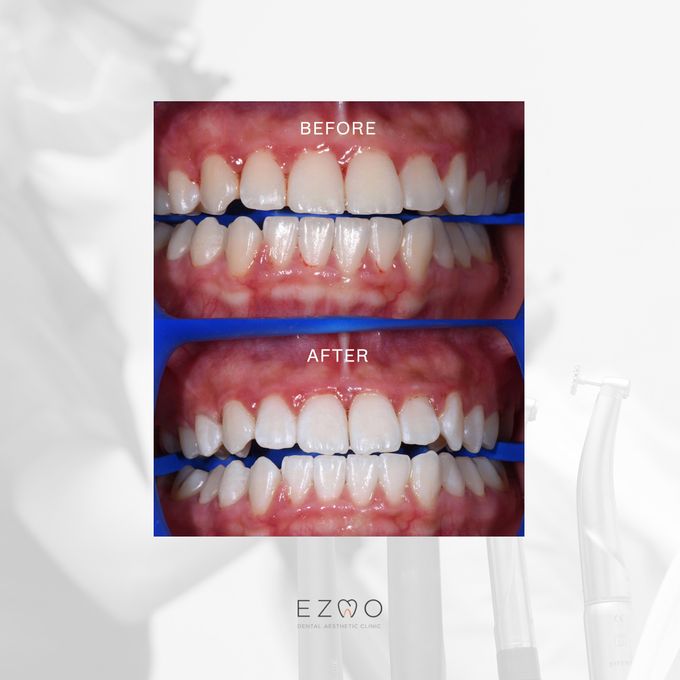Bleaching Treatment by EZMO Dental Clinic - 003 Bleaching Treatment by EZMO Dental Clinic - 003