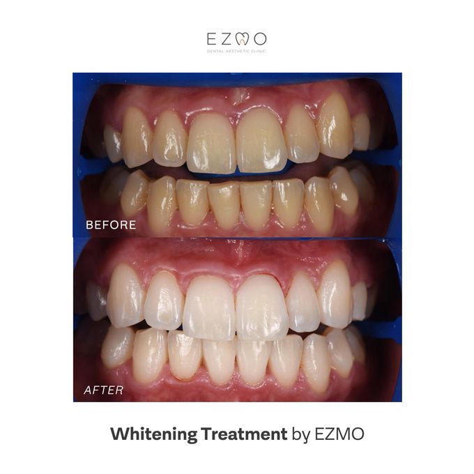 Bleaching Treatment by EZMO Dental Clinic - 001 Bleaching Treatment by EZMO Dental Clinic - 001