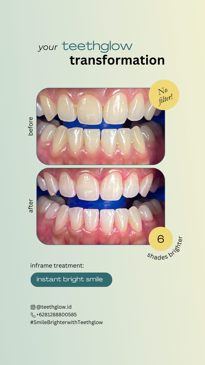 Teeth Whitening Results by Teethglow Teeth Whitening Studio - 003
