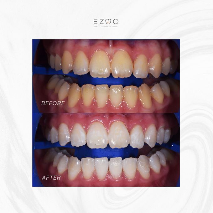 Bleaching Treatment by EZMO Dental Clinic - 002 Bleaching Treatment by EZMO Dental Clinic - 002