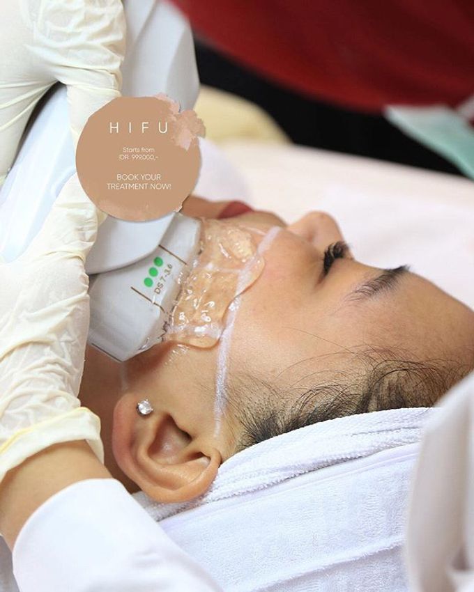 TREATMENT HIFU by Z Glow Clinic - 001 TREATMENT HIFU by Z Glow Clinic - 001