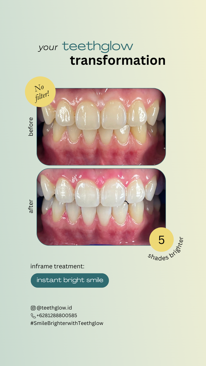 Teeth Whitening Results by Teethglow Teeth Whitening Studio - 005
