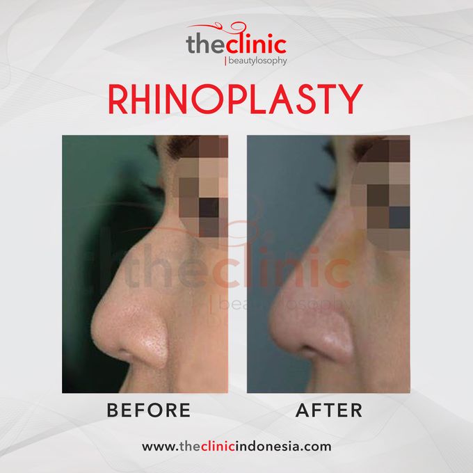 Plastic Surgery by The Clinic Beautylosophy - 004 Plastic Surgery by The Clinic Beautylosophy - 004