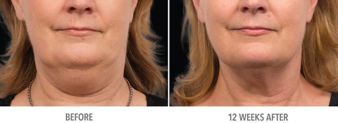 COOLSCULPTING Fat Reduction by la lumiere aesthetics - 004 COOLSCULPTING Fat Reduction by la lumiere aesthetics - 004