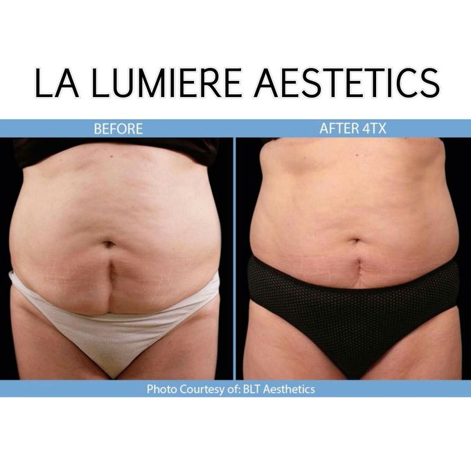 BTL COMBO SLIMMING TREATMENT by la lumiere aesthetics - 009 BTL COMBO SLIMMING TREATMENT by la lumiere aesthetics - 009