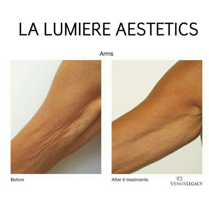 VENUS LEGACY by la lumiere aesthetics - 006 VENUS LEGACY by la lumiere aesthetics - 006
