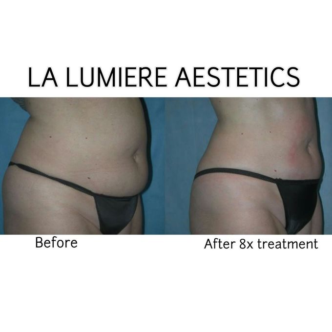 Exillis Ultra 360 by la lumiere aesthetics - 004 Exillis Ultra 360 by la lumiere aesthetics - 004