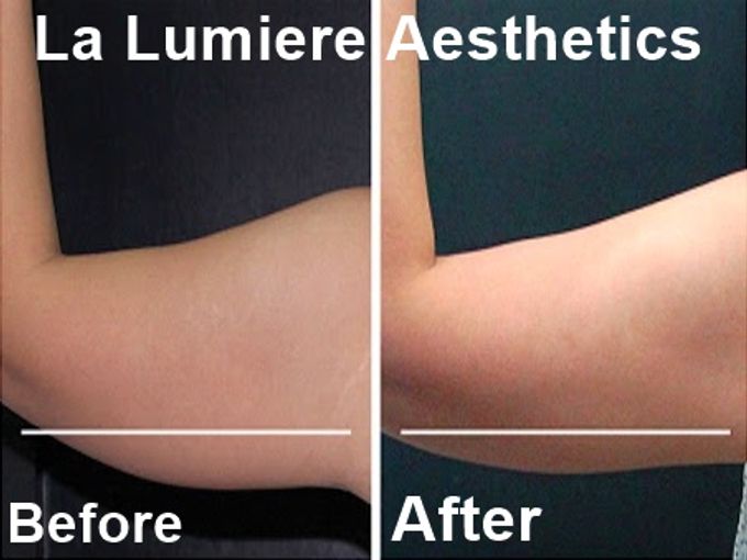 COOLSCULPTING Fat Reduction by la lumiere aesthetics - 003 COOLSCULPTING Fat Reduction by la lumiere aesthetics - 003