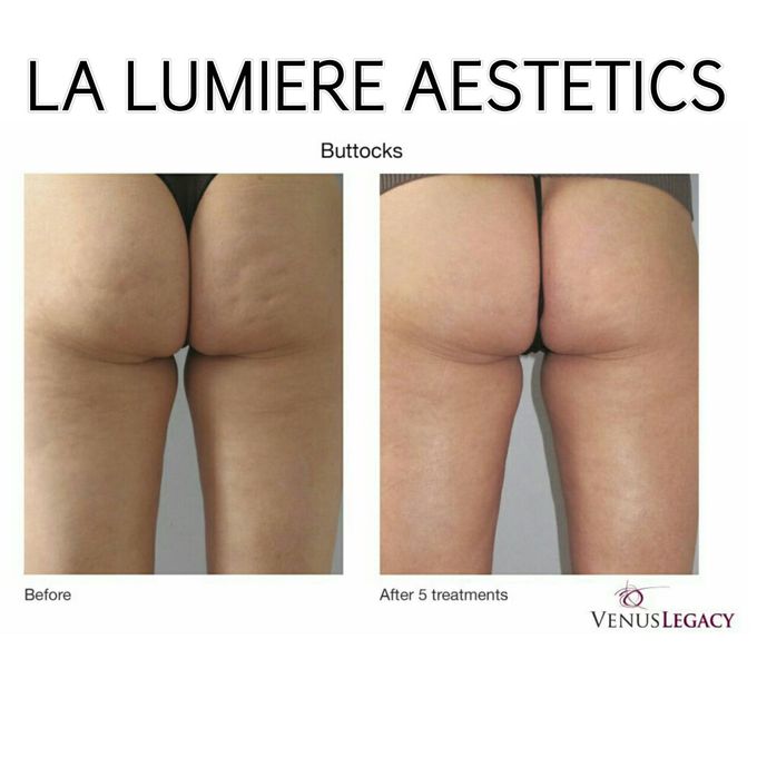VENUS LEGACY by la lumiere aesthetics - 007 VENUS LEGACY by la lumiere aesthetics - 007