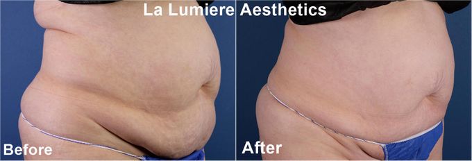 COOLSCULPTING Fat Reduction by la lumiere aesthetics - 005 COOLSCULPTING Fat Reduction by la lumiere aesthetics - 005