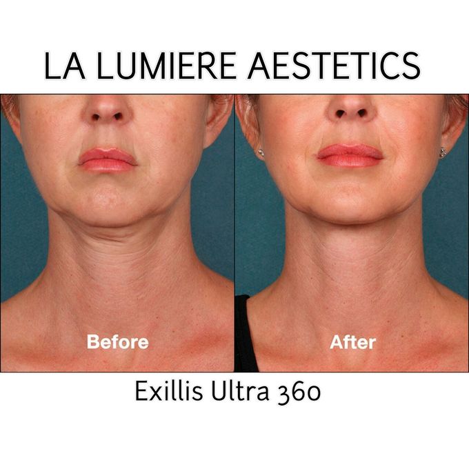 Exillis Ultra 360 by la lumiere aesthetics - 005 Exillis Ultra 360 by la lumiere aesthetics - 005