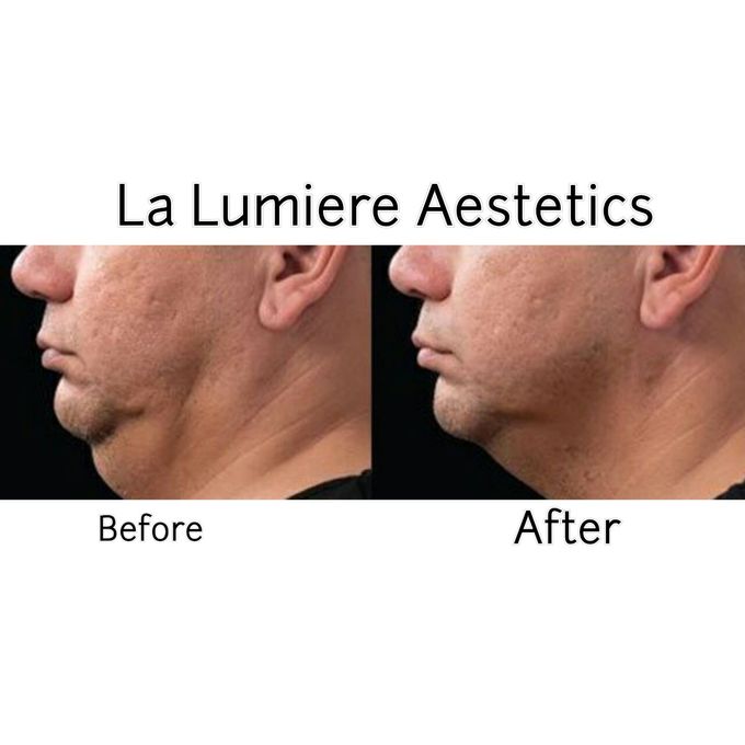 COOLSCULPTING Fat Reduction by la lumiere aesthetics - 002 COOLSCULPTING Fat Reduction by la lumiere aesthetics - 002