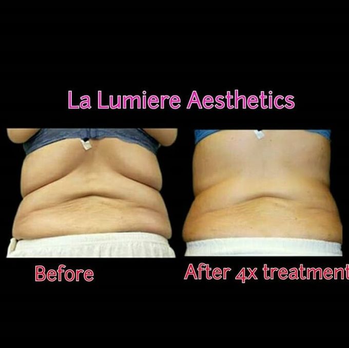 BTL COMBO SLIMMING TREATMENT by la lumiere aesthetics - 007 BTL COMBO SLIMMING TREATMENT by la lumiere aesthetics - 007
