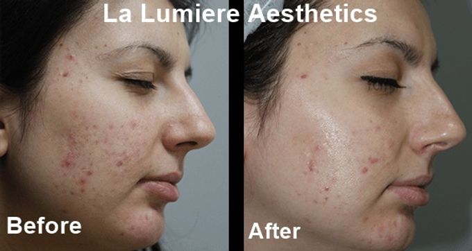 BTL EXILITE SKIN REJUV & BRIGHTENING by la lumiere aesthetics - 003 BTL EXILITE SKIN REJUV & BRIGHTENING by la lumiere aesthetics - 003