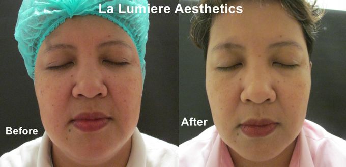 BTL EXILITE SKIN REJUV & BRIGHTENING by la lumiere aesthetics - 005 BTL EXILITE SKIN REJUV & BRIGHTENING by la lumiere aesthetics - 005