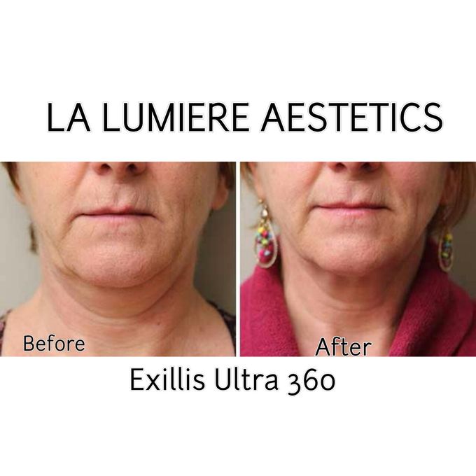 Exillis Ultra 360 by la lumiere aesthetics - 006 Exillis Ultra 360 by la lumiere aesthetics - 006