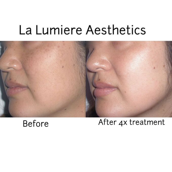 BTL EXILITE SKIN REJUV & BRIGHTENING by la lumiere aesthetics - 004 BTL EXILITE SKIN REJUV & BRIGHTENING by la lumiere aesthetics - 004