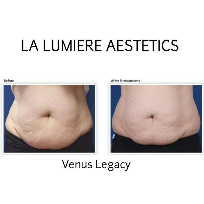 VENUS LEGACY by la lumiere aesthetics - 004 VENUS LEGACY by la lumiere aesthetics - 004