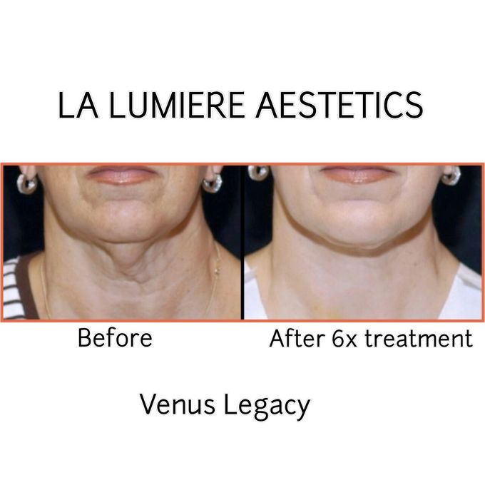VENUS LEGACY by la lumiere aesthetics - 005 VENUS LEGACY by la lumiere aesthetics - 005