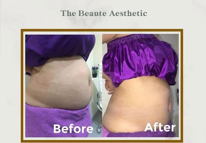Clatuu Fat Freezing/Cryolipolisis by The Beaute Aesthetic - 002 Clatuu Fat Freezing/Cryolipolisis by The Beaute Aesthetic - 002