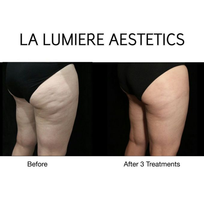 BTL COMBO SLIMMING TREATMENT by la lumiere aesthetics - 008 BTL COMBO SLIMMING TREATMENT by la lumiere aesthetics - 008