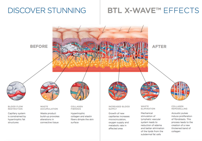 BTL COMBO SLIMMING TREATMENT by la lumiere aesthetics - 006 BTL COMBO SLIMMING TREATMENT by la lumiere aesthetics - 006