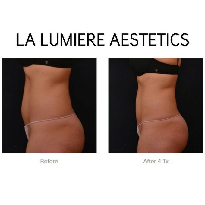 Exillis Ultra 360 by la lumiere aesthetics - 007 Exillis Ultra 360 by la lumiere aesthetics - 007