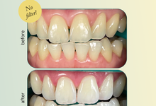 Teeth Whitening Results by Teethglow Teeth Whitening Studio